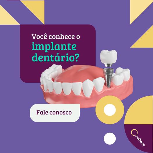 Você conhece o implante dentário? Fale conosco
